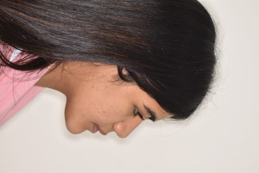 Class III correction with orthognathic surgery after treatment