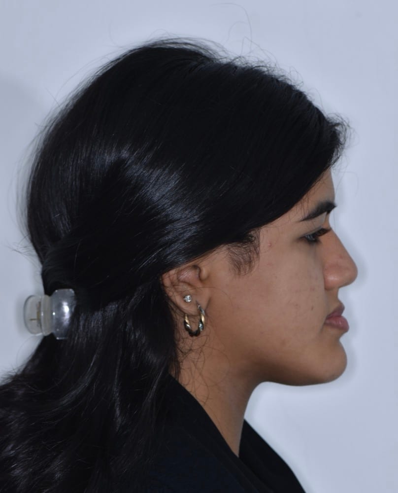 Class III correction with orthognathic surgery before treatment