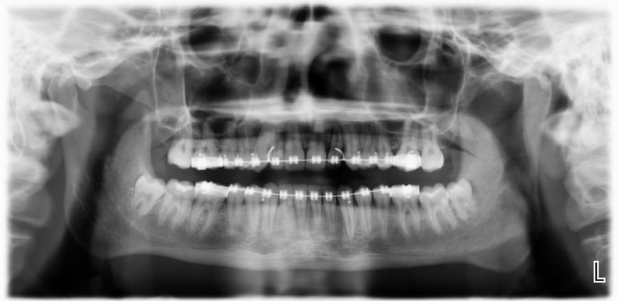 Impacted canine alignment after treatment