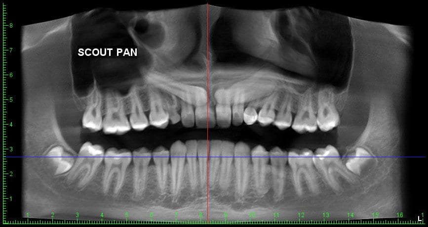 Impacted canine alignment before treatment
