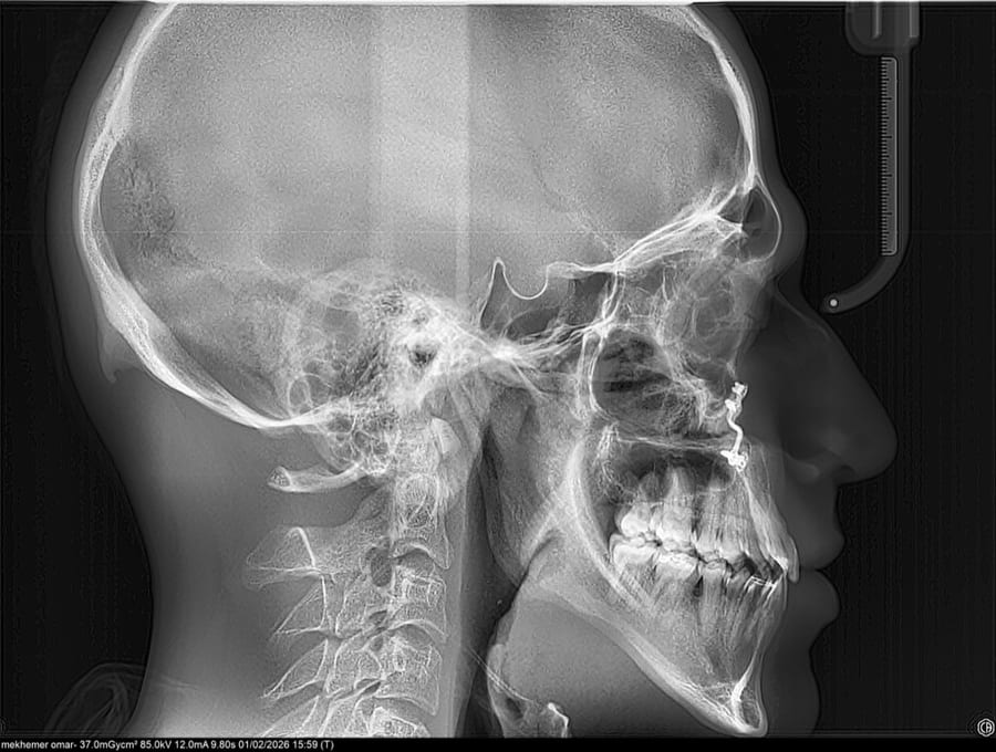 Surgical orthodontic correction after treatment