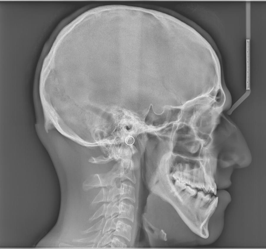 Surgical orthodontic correction before treatment